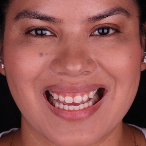 Testimonials porcelain veneers in mexico 9